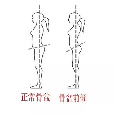 怎么分辨是驼背还是骨盆前倾,怎么判断骨盆前倾图图1