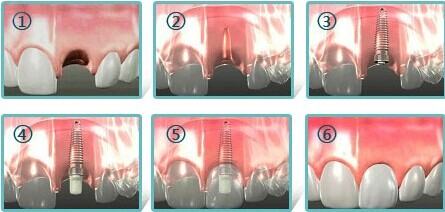 牙齿怎么样种植,牙齿怎样种植牙的图1