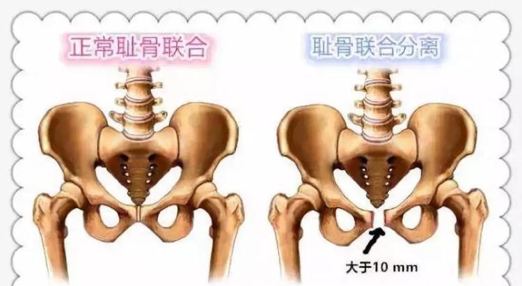 耻骨在哪里 耻骨位置是哪里,男性耻骨是哪个部位图2