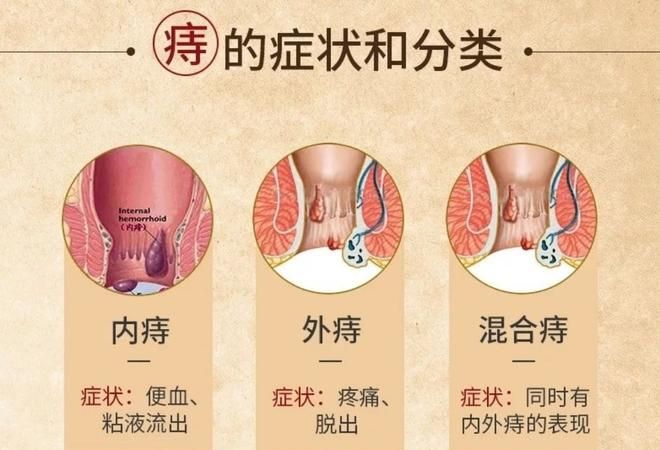 避免痔疮出血的方法推荐给大家,艾滋病的预防和治疗措施图4