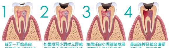 虫牙怎么办 蛀牙的成因,有蛀牙是什么原因引起的图3