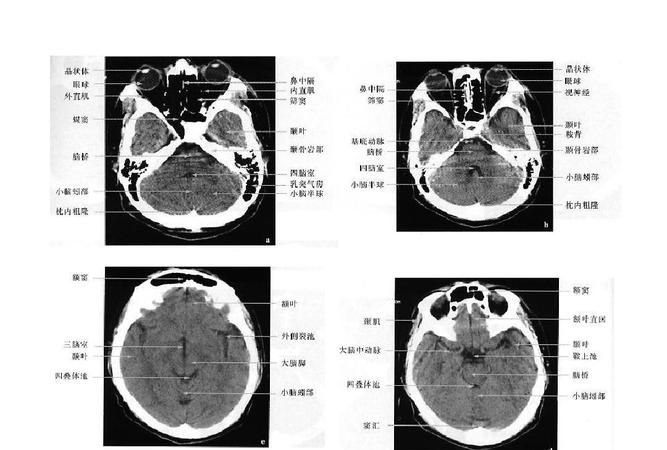 如何看懂磁共振片子,mri检查报告单如何看图3