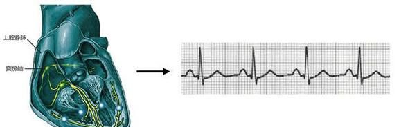 什么是窦性心律正常,窦性心律是正常现象图2