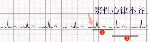 什么是窦性心律正常,窦性心律是正常现象图3