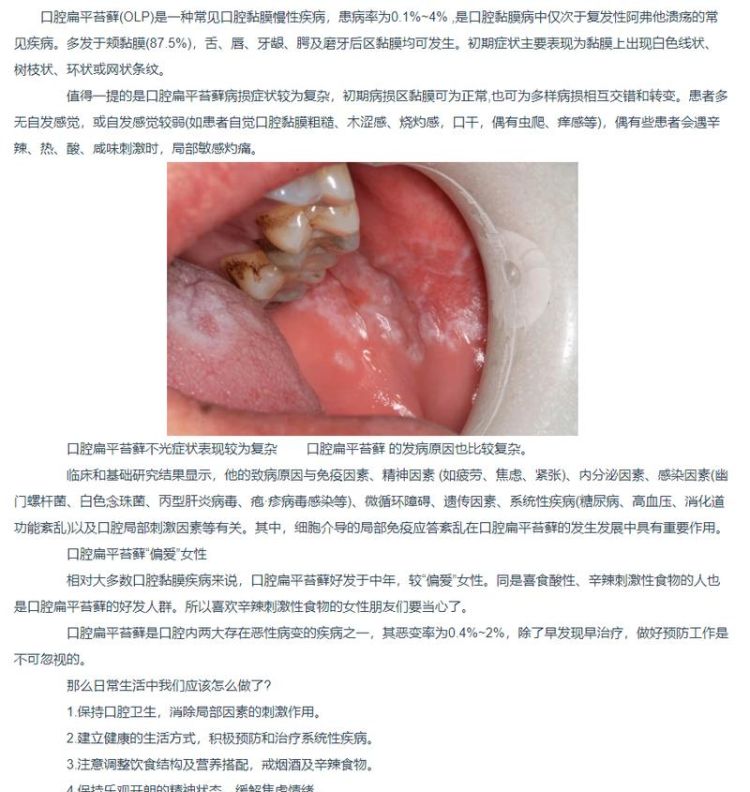 口腔扁平苔藓是什么病,口腔扁平苔藓是什么病图2