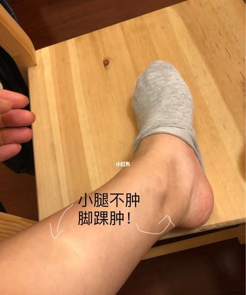 小腿水肿怎么消除,用盐水泡脚能消除小腿浮肿图4