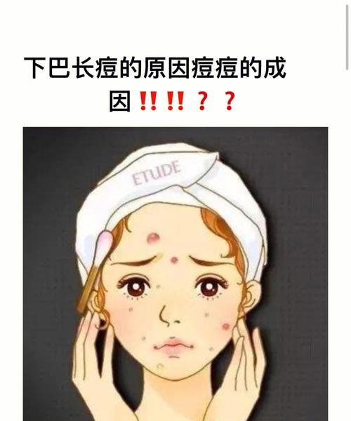 下巴上长痘痘是什么原因,下巴长痘什么原因图3