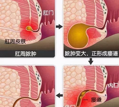 肛门直肠疾病可以买保险,肛瘘手术商业保险给报销图4