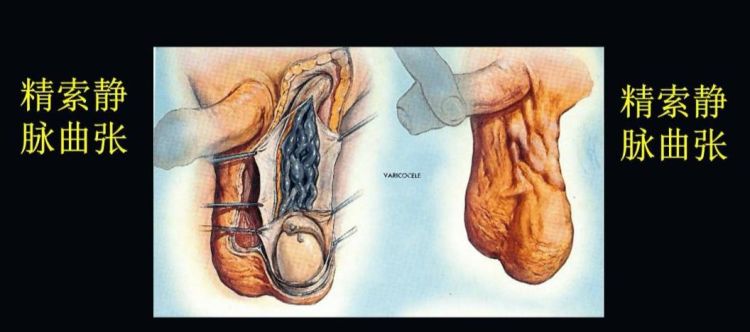 精索静脉曲张危害有哪些,男人的精索静脉曲张有什么危害