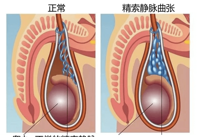 精索静脉曲张危害有哪些,男人的精索静脉曲张有什么危害图2