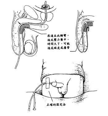 导尿管拔掉后如何尿出,拔了导尿管后尿不出来怎么办图4